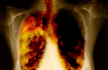 cancer_pulmon