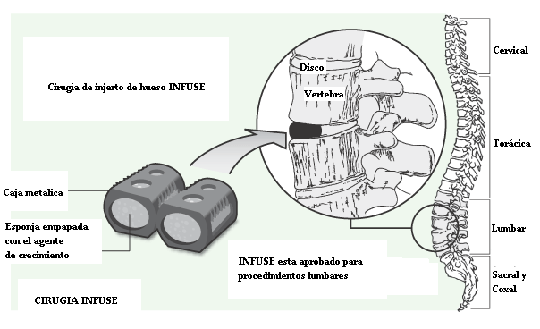 cirugia_de_columna_INFUSE