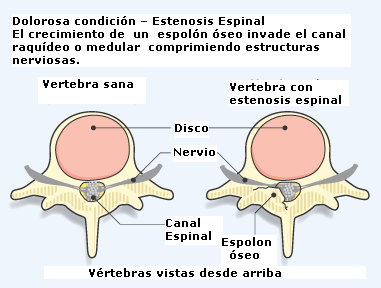 estenosis_espinal