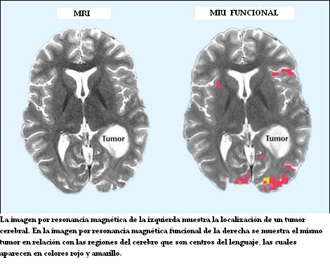 MRI_funcional