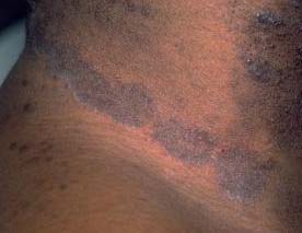 tinea corporis