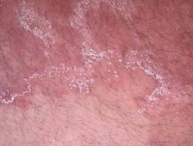 tinea corporis