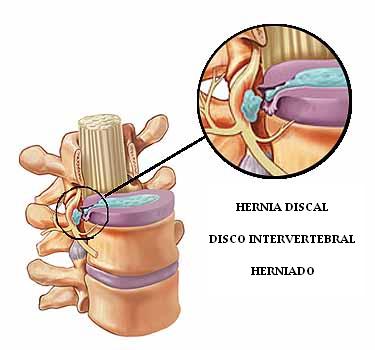 hernia_discal