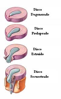 pregresion_hernia_discal