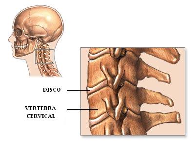 lordosis_cervical