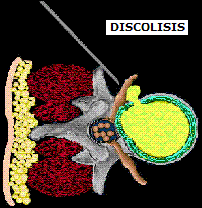 discolosis