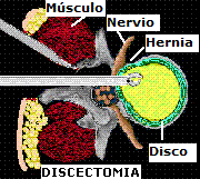 discectomia