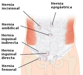 hernias_abdominales_tipos