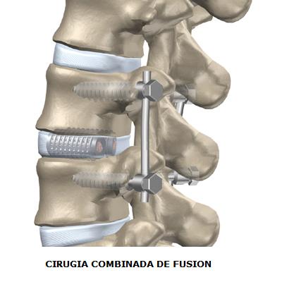 cirugia_combinada_de_fusion