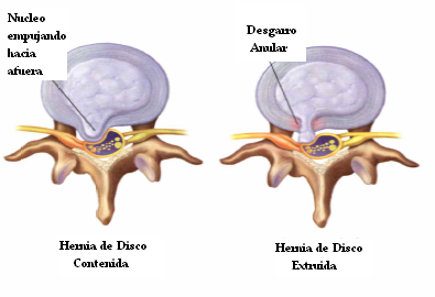 desgarro_anular