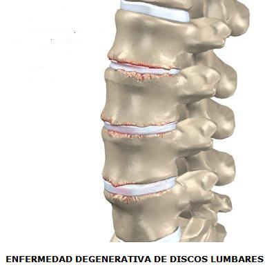 enfermedad_degenerativa_disco_lumbares