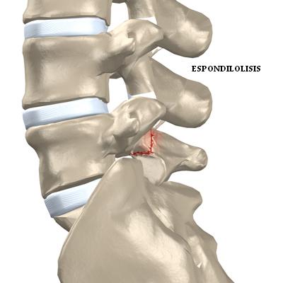 espondilolisis