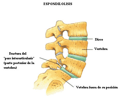 espondilolisis_1