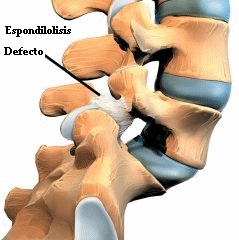 espondilolisis_2