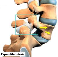 espondilolistesis