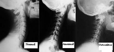 lordosis_cervical