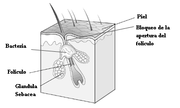 microcomedon