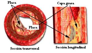 arterioesclerosis_coronaria