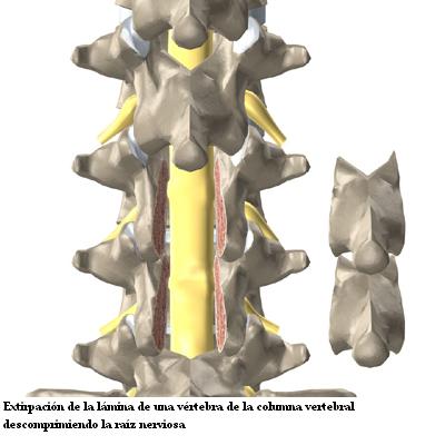 extirpacion_lamina_vertebral