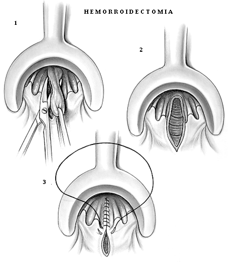 HEMORROIDECTOMIA