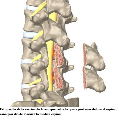 laminectomia_lumbar