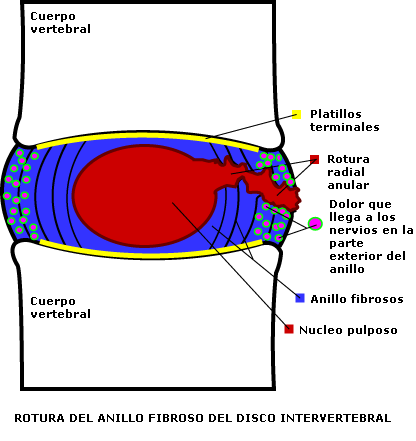 ruptura_anillo_fibroso