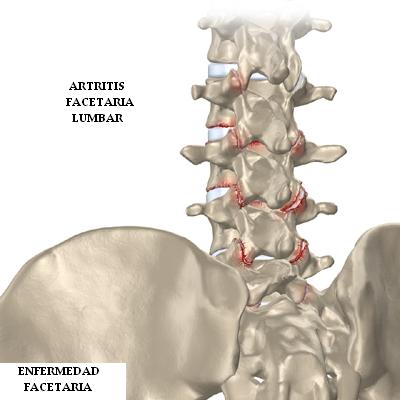 artritis_facetaria