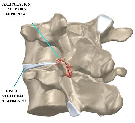 articulacion_facetaria_artritica