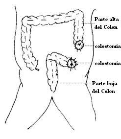 colostomia