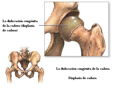 displasia_de_cadera