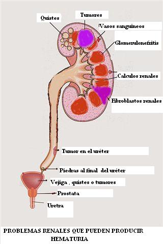 ENFERMEDADES_RENALES