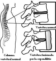 espondilitis