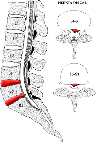 hernia_discal