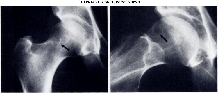 hernia_pit_con_fibrocolageno
