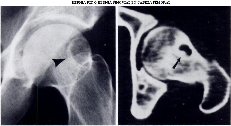 hernia_pit_cabeza_femoral