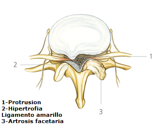 hipertrofia_ligamento_amarillo