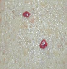 hemangioma_capilar