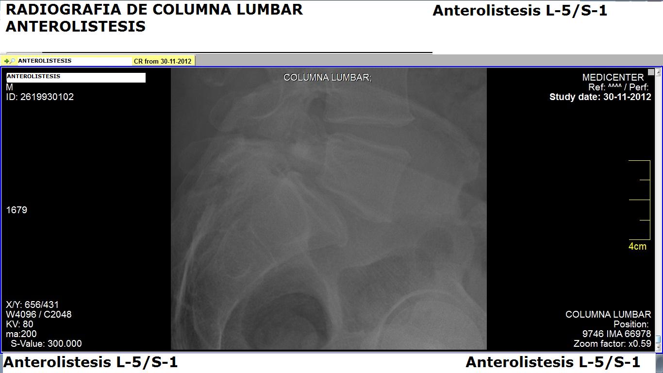 radiografia_lumbar