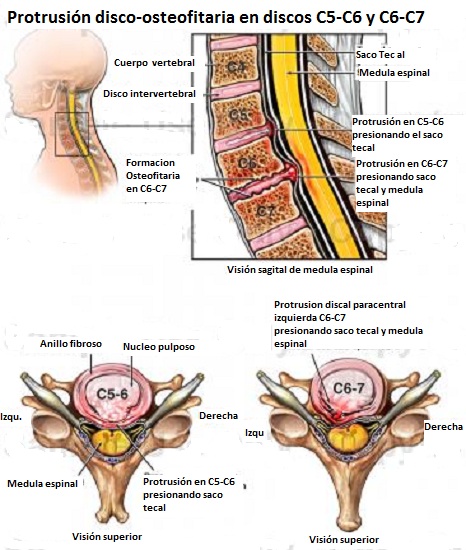 protrusion_disco_osteofitaria