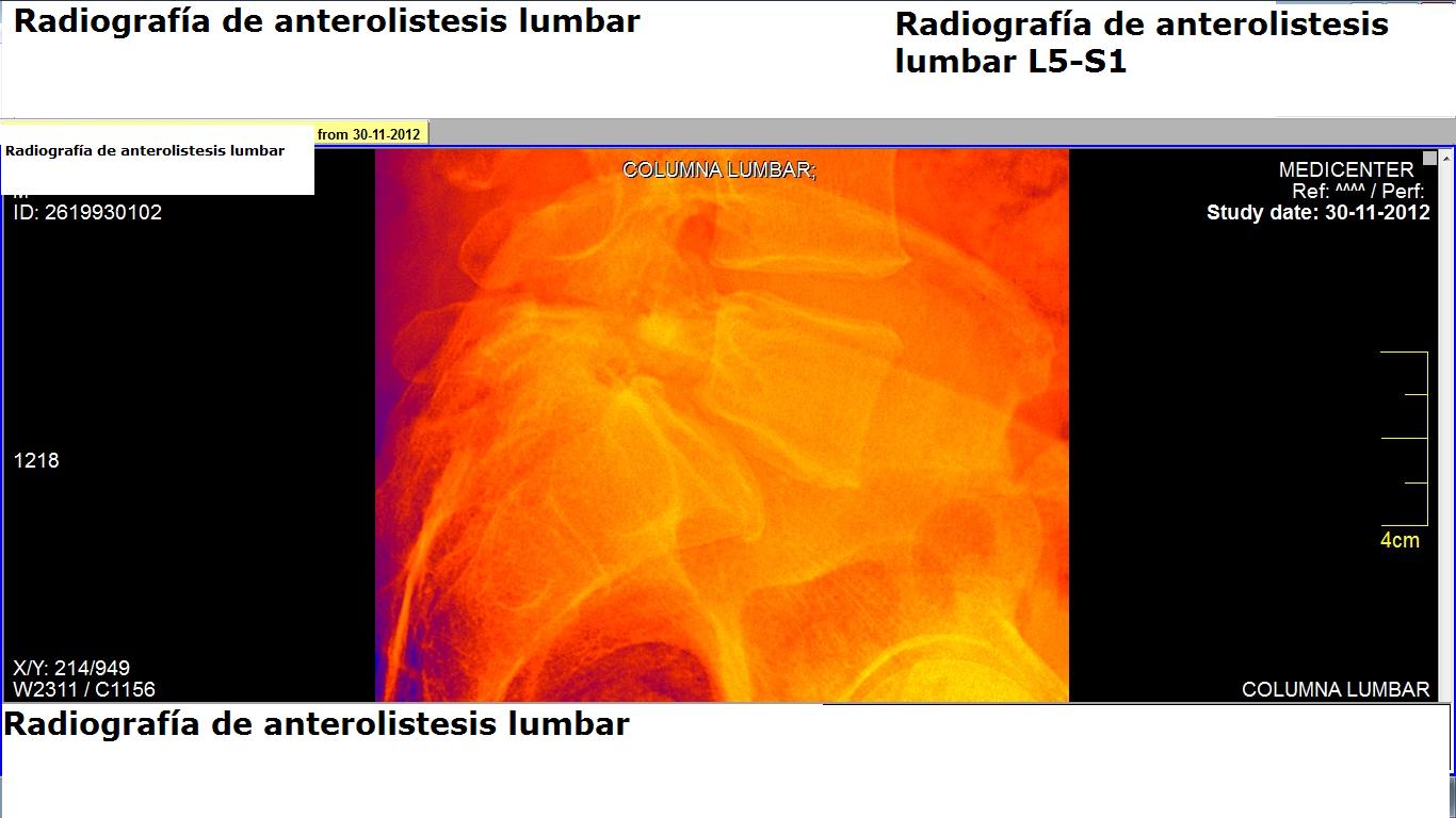 anterolistesis_lumbar