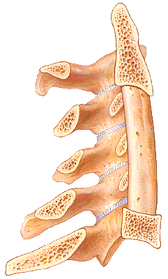 corpectomia