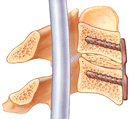 fusion_cervical_instrumentada