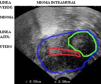 mioma_intramural