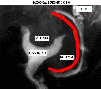 mioma_submucoso