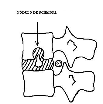 Nodulo_de_Schmorl