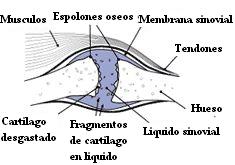 articulacion_osteoartritica