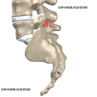 espindilolistesis