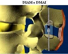Dispositivo para Movimiento Asistido Intervertebral (DIAM)