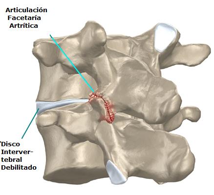 articulacion_facetaria_artritica