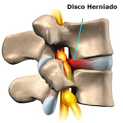 disco_herniado